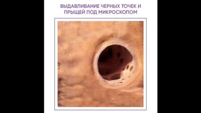 Видавлювання прищів і чорних цяток під мікроскопом