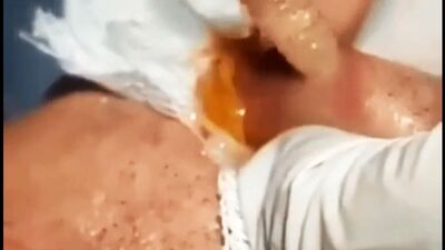 Rimozione di una larva di tafano dal labbro