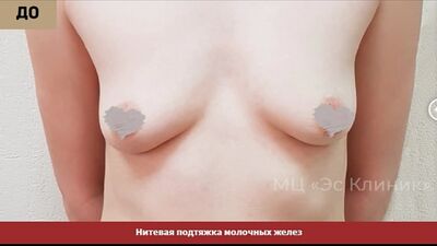 Lifting des seins par fils (3)