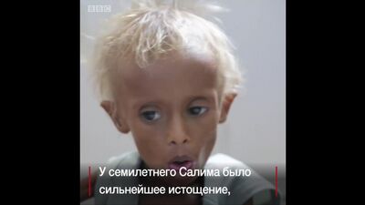 Milhões de crianças sofrem com a fome no Iémen